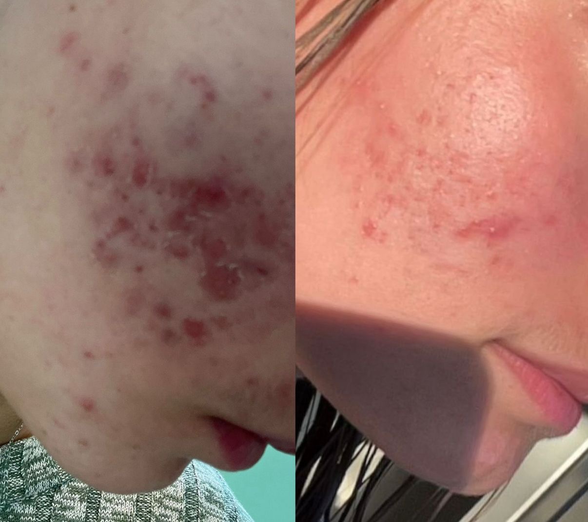Voor en na behandeling - van acne naar stralende huid bij Mooi Instituut Zevenbergen