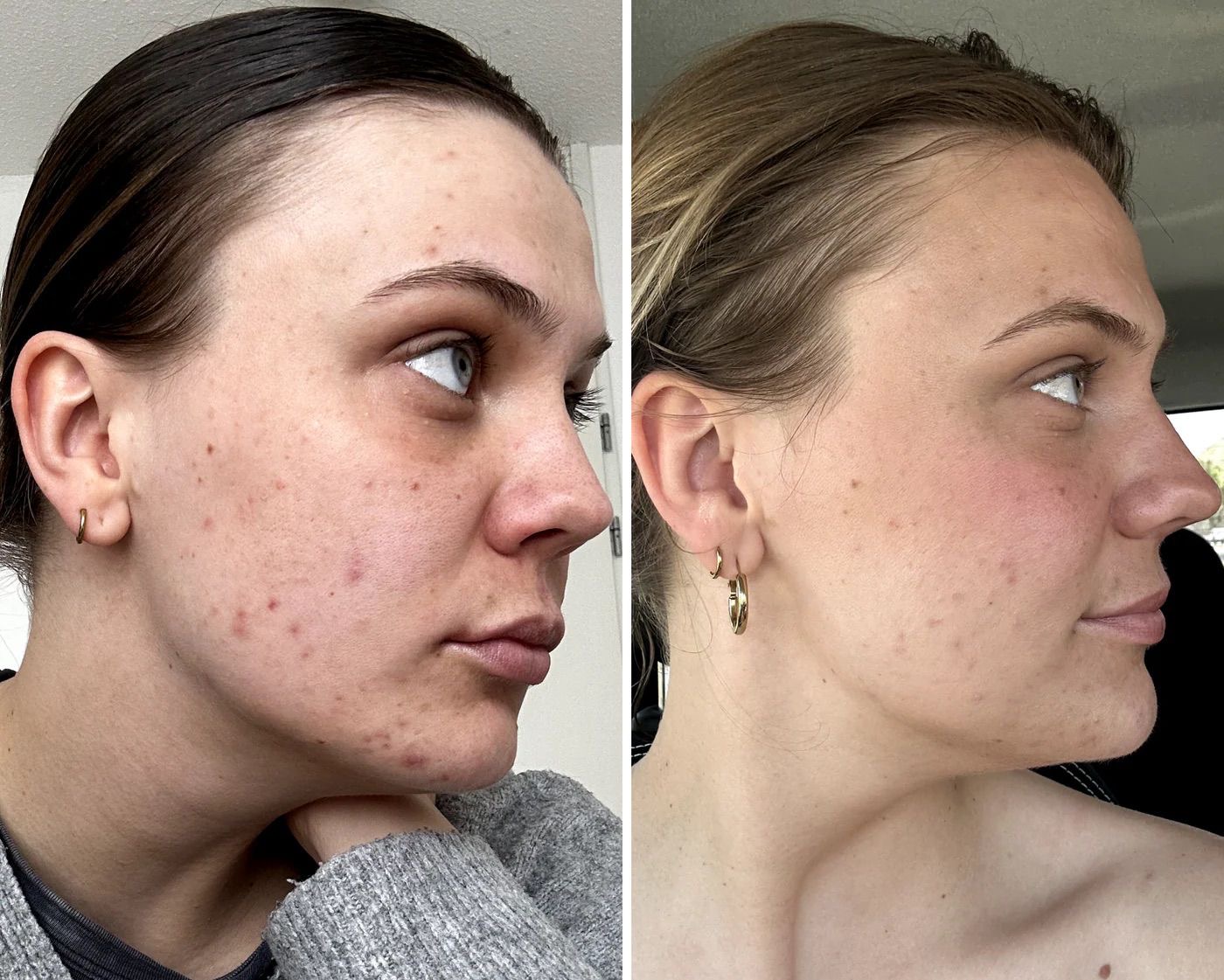 Voor en na behandeling - acne naar gave huid bij Mooi Instituut Zevenbergen